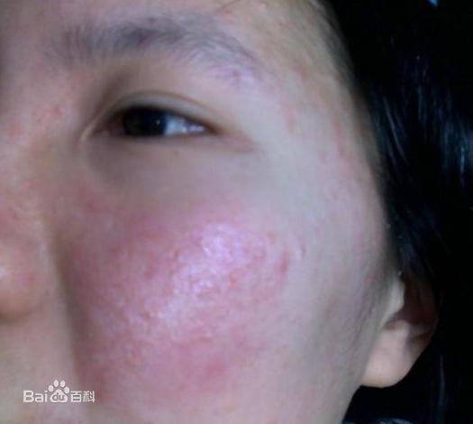 脸部过敏吃凉瓜好吗,凉瓜对过敏肌肤的影响解析